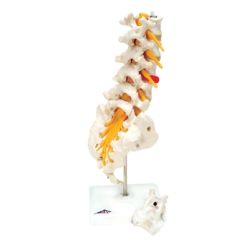 Muguras jostas daļas kanāls ar noslīdējušu sānu skriemeļa disku, Lumbar Spinal Column with Dorso-Lateral Prolapsed Intervertebral Disc